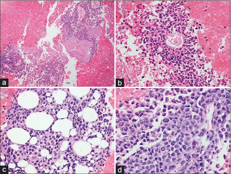 Cell block preparation (H and E) (a). Loosely cohesive clusters of malignant cells and background of necrosis (×200) (b). Radiating growth pattern around blood vessels and poor cell-to-cell adhesion (×400) (c). Adipose tissue infiltration by tumor cells (×400) (d). High N/C ratio, coarse chromatin pattern, irregular nuclear contours, occasional conspicuous nucleoli, and scant eosinophilic cytoplasm (×400, digitally magnified). (For improved resolution with enlargement of all images, please refer to the digital/online version of the article)