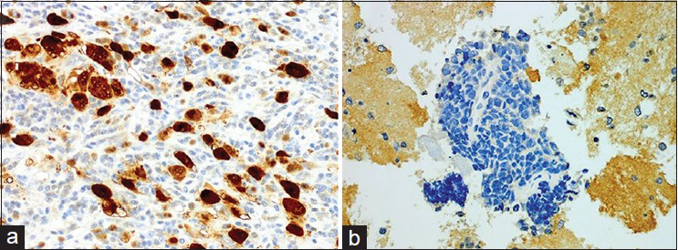 S-100 protein expression (immunohistochemistry). (a) Positive control, strong and diffuse immunoreactivity with S-100 antibody. (b) Negative S-100 immunostaining in the current case (both × 400, digitally magnified). (For improved resolution with enlargement of all images, please refer to the digital/online version of the article)