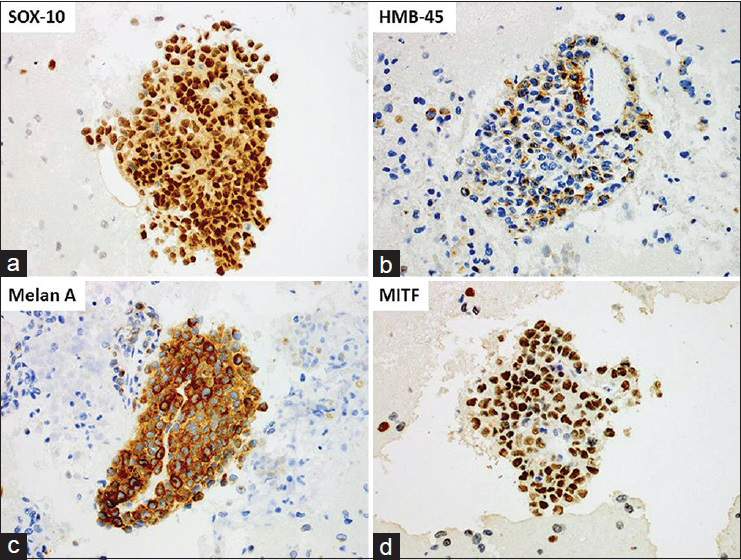 Expression of other melanocytic-associated markers (immunohistochemistry). Positive immunostaining for: (a) SOX-10, nuclear (b) HMB-45, cytoplasmic, finely granular (c) Melan-A, cytoplasmic, diffuse (d). Microphthalmia transcription factor, nuclear (all × 400, digitally magnified). (For improved resolution with enlargement of all images, please refer to the digital/online version of the article)