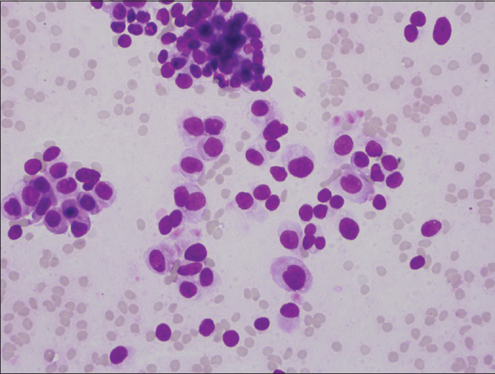 Photomicrograph of intermediate-grade neuroendocrine tumor. Cells have smooth nuclear contours, but greater than a 3-fold variation in nuclear size (Diff-Quik, ×400)