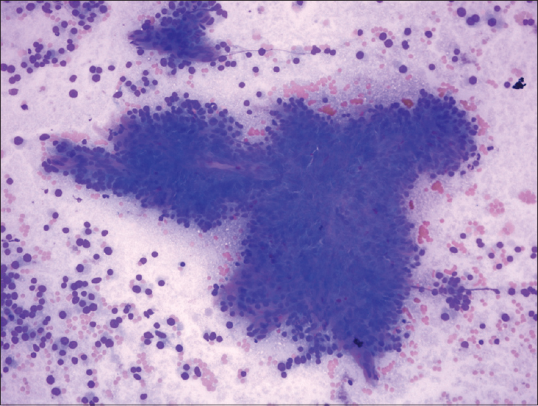 Hypercellular smear with prominent single cells, insular pattern, and transgressing vessels (Diff-Quik, ×40)