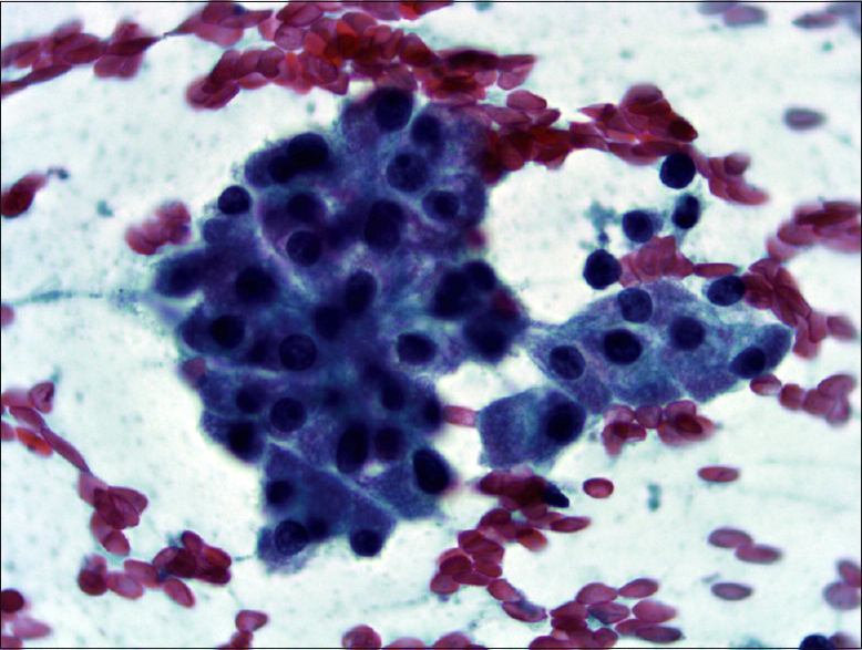 Cells have delicate eosinophilic cytoplasm (Pap, ×400)