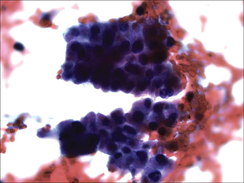 Cells have a high nuclear/cytoplasmic ratio, nuclei are round, slightly hyperchromatic and relatively uniform with macronucleoli (Pap, ×400)