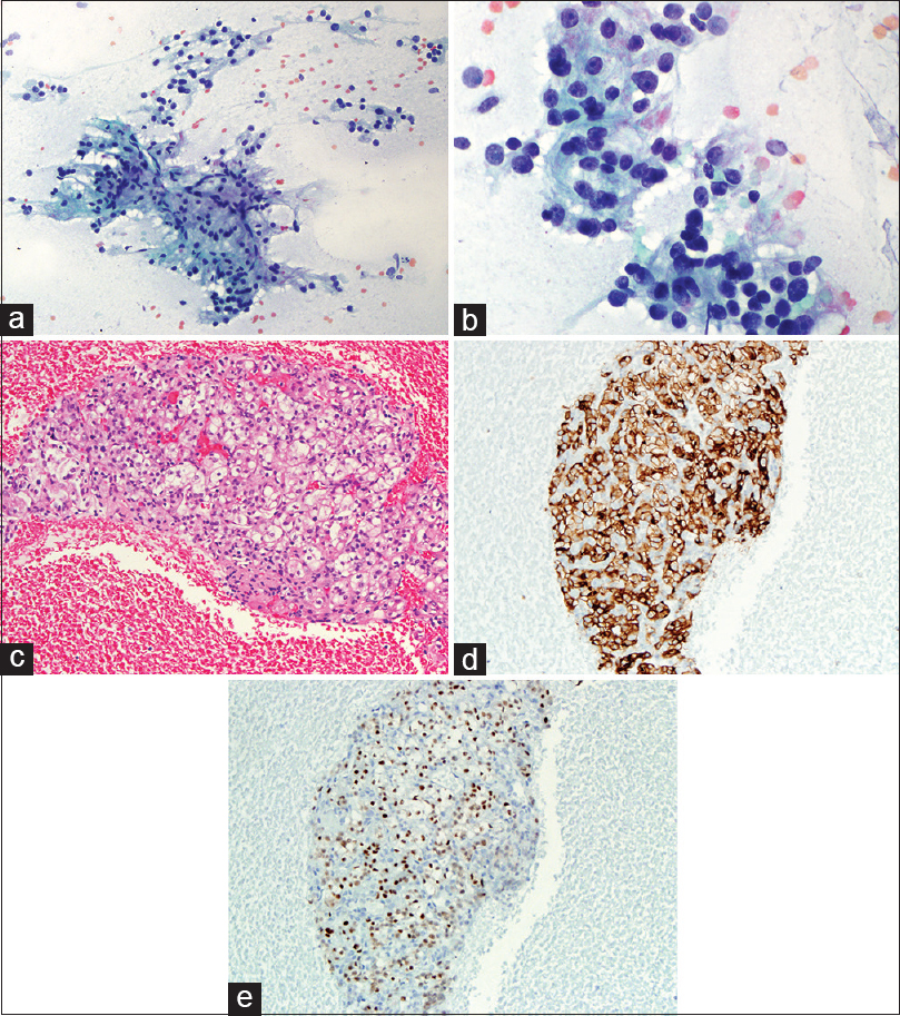 (a) Cytology smear of an EUS-fine needle aspiration of pancreas showing cohesive cluster of epithelial cells with intersecting blood vessels (Pap, ×200). (b) High power view of 2A showing renal cell carcinoma tumor cells with large nuclei, moderate to abundant vacuolated cytoplasm, and visible nucleoli (Pap, ×400). (c) Cell block of 2A showing the typical renal cell carcinoma with tumor cells of clear cytoplasm (H and E, ×200). (d) Immunohistochemical stain of EMA on the above cell block showing the tumor cells are positive for epithelial membrane antigen (×200). (e) Immunohistochemical stain of PAX-8 on the cell block showing the tumor cells are positive (nuclear staining) for PAX-8 (×200)