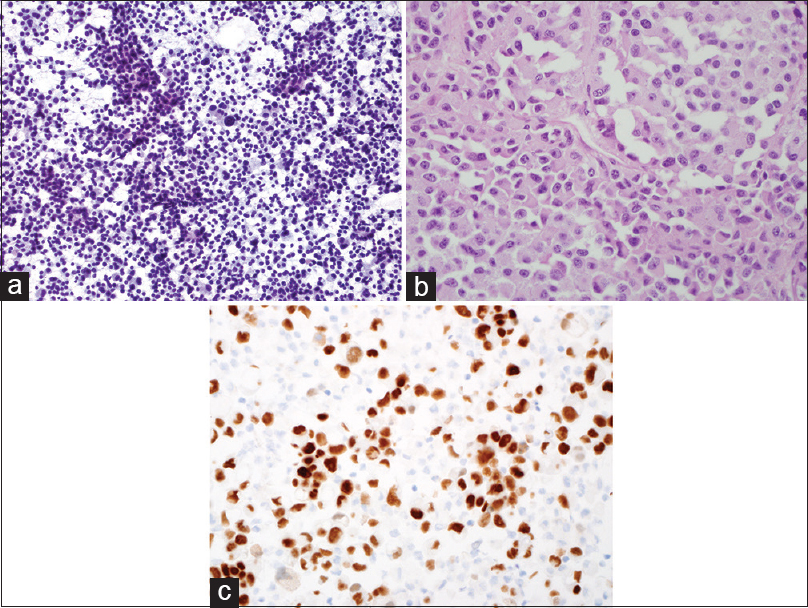 (a) Cytology smear of another EUS-fine needle aspiration of pancreas showing large discohesive tumor cells with abundant granular cytoplasm (Pap, ×200,). (b) Cell block of 3A showing the large tumor cells with abundant eosinophilic cytoplasm, large nuclei, and prominent nucleoli (H and E, ×400). (c) Immunohistochemical stain of PAX-8 on the cell block showing the tumor cells are positive (nuclear staining) for PAX-8 (×400)