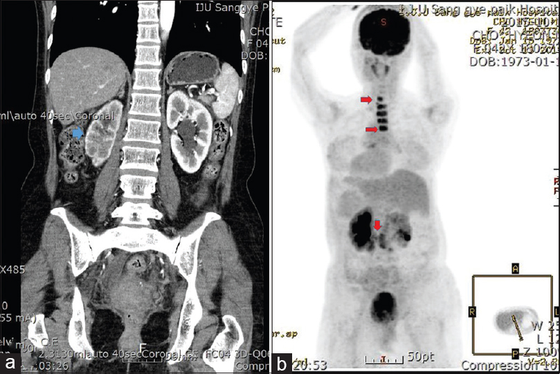 (a) Abdominopelvic computed tomography image shows marked hydronephrosis (blue arrow) affecting the right kidney without an obvious mass in the upper urinary tract. (b) Positron emission tomography/computed tomography revealed multiple high signal intensities (C7-T4 spinal vertebrae, para-aortic lymph nodes, red arrows) suggesting metastatic carcinoma from an unknown primary