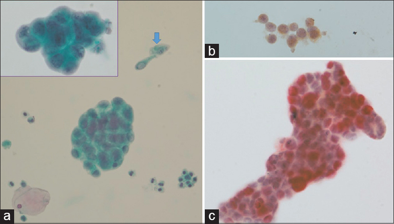 (a) Urine cytology preparation containing clusters of atypical epithelial cells in a background of umbrella cells (blue arrow) and inflammatory cells. The atypical cells are arranged in three-dimensional clusters, resembling an adenocarcinoma (Inset) (Pap, ×400). (b) The umbrella cells only express cytokeratin 20 antigen (p53/CK20 double immunostaining, ×400). (c) The atypical cells demonstrate a distinct pattern of double staining: red nuclei (p53) and brown cytoplasm (cytokeratin 20) (p53/CK20 double immunostaining, ×400)