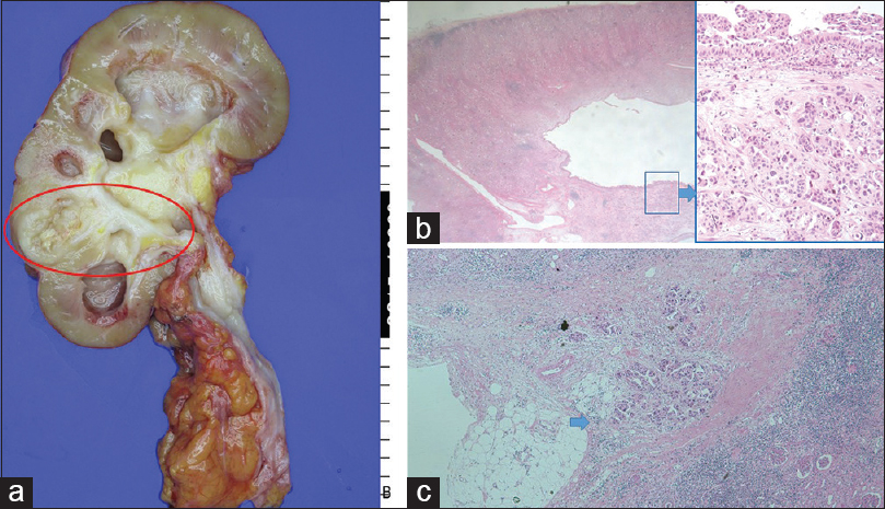 (a) Nephroureterectomy specimen showing cystically dilated renal pelvis and ill-defined mass (2.5 cm) in the lower renal pelvis (red circle). (b) The scanning power view shows relatively intact urothelium and underlying atrophic renal parenchyma (H and E, ×10) Papillary proliferation of urothelium and underlying micropapillary nests in lacunar spaces suggest micropapillary urothelial carcinoma (Inset) (H and E, ×100). (c) Tumor cells are seen infiltrating the perirenal fat tissue (blue arrow) (pT4 disease) (H and E, ×10)