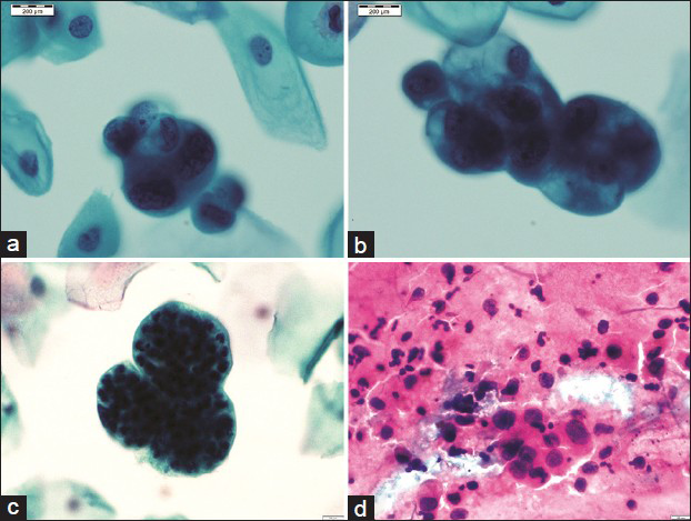 A panel of microphotographs of Pap samples reported as endometrial adenocarcinoma: (a and b) Three-dimensional clusters of atypical endometrial cells showing nucleomegaly, irregular nuclear membranes, and prominent nucleoli (Pap, ×100); (c) bag of polymorphs (Pap, ×100); (d) conventional smears showing loosely cohesive cluster of atypical glandular cells with dispersed population of similar cells (Pap, ×40)