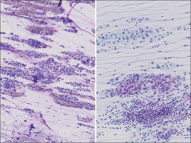 Low power image of aspirate smear (left, Diff-Quik, ×40; right, Papanicolaou ×100) showing high cellularity with abundant extracellular myxoid material imparting a streaming appearance to the slide, admixed with single cells and occasional larger clusters