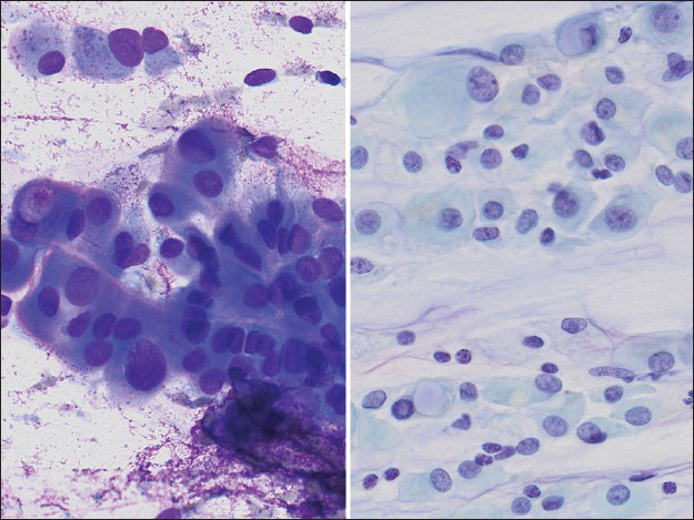 High power image of the aspirate smear slides (left Diff-Quik, ×400; right Papanicolaou, ×400) showing cells with abundant, dense cytoplasm, well-defined cytoplasmic borders, cytoplasmic windows, occasional vacuoles, and round to oval nuclei, pale chromatin, and moderate variation in nuclear size