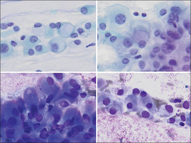 Various vacuoles appreciated in the aspirate smears, varying from large, solitary vacuoles displacing the nucleus into an eccentric position (upper left, Papanicolaou, ×400), large solitary perinuclear vacuoles with grey-light blue material suggestive of mucin (upper right, Papanicolaou, ×400), or multiple small vacuoles, often overlying the nucleus (lower left and lower right, Diff-Quik, ×400)