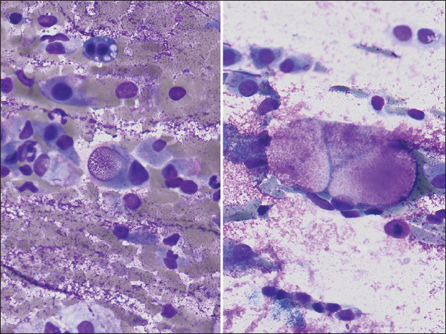 Some tumor cells had intracytoplasmic vacuoles filled with material which stained magenta on Diff-Quik stain (×400, right and left)