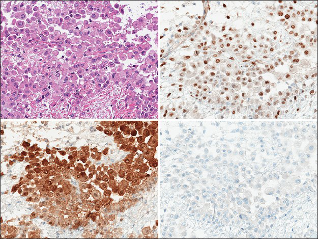 The pleural decortication specimen demonstrated infiltrative sheets of cells with abundant eosinophilic cytoplasm and a discohesive arrangement within a myxoid stroma (upper left, H and E, ×400), which were positive for WT1 (upper right, ×400), calretinin (lower left, ×400) and negative for TTF-1 (lower right, ×400), consistent with a malignant mesothelioma