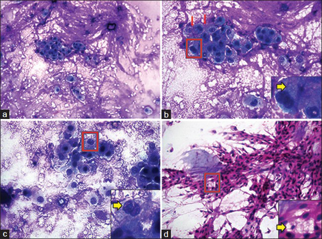 Squash smear cytology of sellar lesion. (a) Cellular smear showing tumor cells in clusters and singles against a metachromatic fibrillary mxyoid background (MGG, ×200). (b) Tumor cells are large round to oval cells having distinct cell borders, moderate to abundant cytoplasm, and mildly pleomorphic vesicular nucleus. Individual tumor cells are surrounded by fibrillary matrix (red arrow). Some of the tumor cells show vacuolated cytoplasm (Inset [zoomed] with yellow arrow) (MGG, ×400). (c) Tumor cells show binucleation and noticeable nucleoli (Inset (zoomed) with yellow arrow) (MGG, ×400). (d) Cellular smear showing polygonal tumor cells in clusters and sheets with myxoid material in the background. Tumor cells are polygonal/round/oval/spindle shaped. Some of the tumor cells (physaliphorous) show cytoplasmic vacuoles of varying size (Inset [zoomed] with yellow arrow) (H and E, ×200)