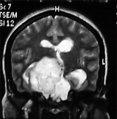 Magnetic resonance imaging showed a large lobulated heterogeneously enhancing extra-axial lesion measuring 5.8 cm × 5.3 cm × 4.3 cm in the sellar, parasellar, and suprasellar regions with erosion of bony sellar and clivus with extension