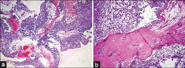 Histology of sellar lesion. (a) Low power view of lobulated tumor tissue with areas of hemorrhage (H and E, ×100). (b) Tumor tissue showing physaliphorous cells in lobules separated by fibrous septa (H and E, ×200)