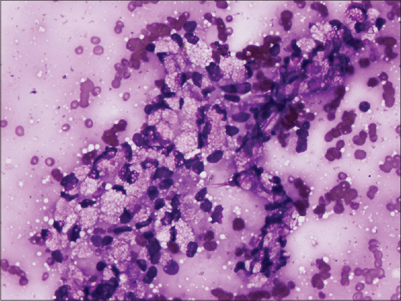 Most of the cells had multiple fine vacuoles in the cytoplasm (MGG, ×400)