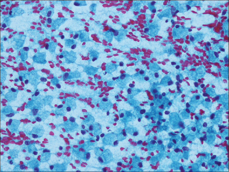 Many singly scattered foamy tumor cells simulating histiocytes (Pap, ×400)