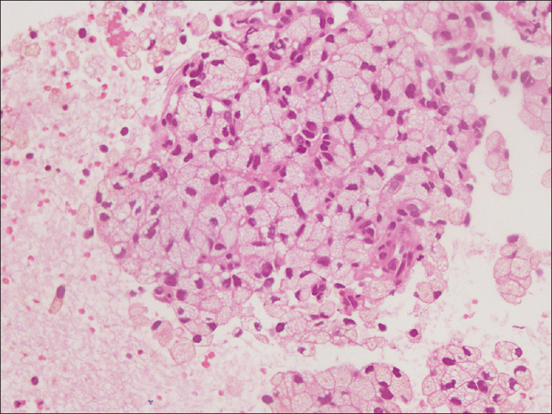 Section from cell block shows small nests of tumor cells (H and E, ×400)