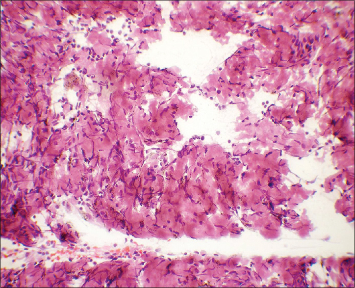 Flocculent material was eosinophilic in Papanicolaou stain. Many spindle stromal cells were seen haphazardly intermixed with it (×400)