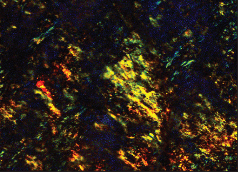 Apple green birefringence under polarized light, Congo red staining, lymph node (×400)