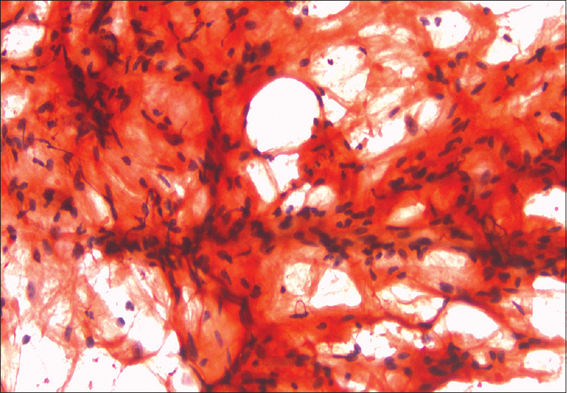 Congo red staining shows linear deposits of amyloid on abdominal fat pad aspiration(×400)