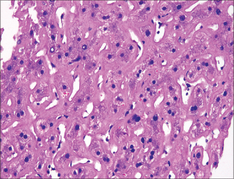 Liver biopsy showing amyloid deposition (H and E, ×400)