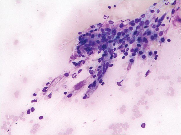 Fibrovascular fragment associated with round cells (Diff-Quik stain, ×200)