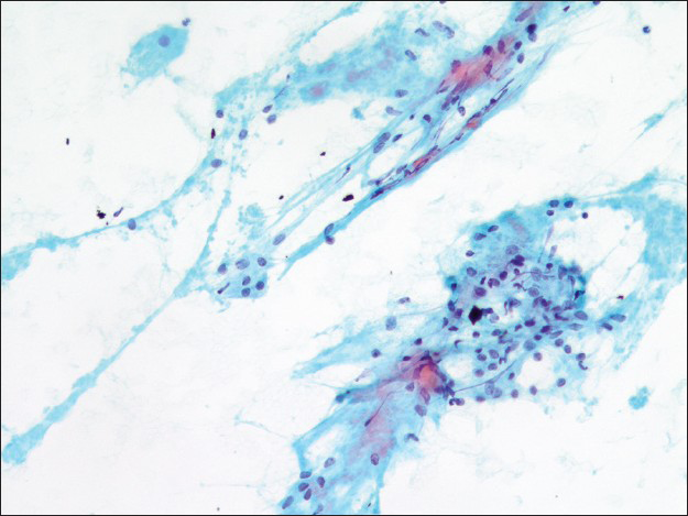 Dense collagenous stromal tissue associated with bland appearing round cells (×200)