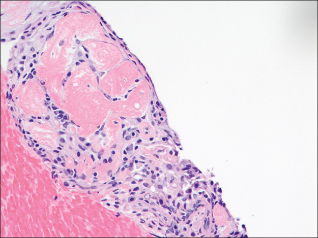 The papillary front on the cell block lined by a single layer of flat surface cells is focally hyalinized. Scattered round cells and inflammatory cells are observed in the center of this structure (H and E, ×200)