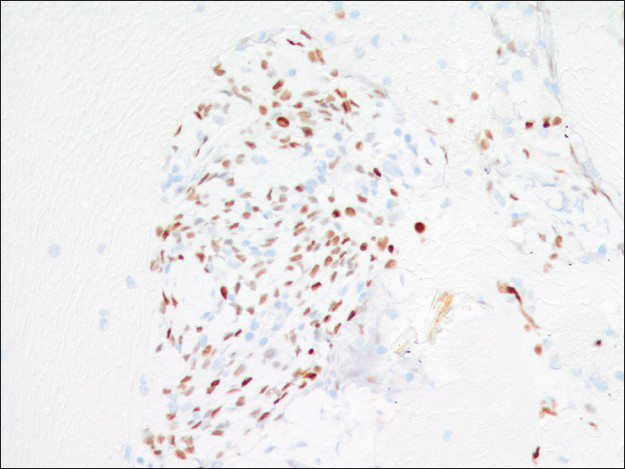 Both surface and round cells are positive for thyroid transcription factor-1 immunostain (×200)