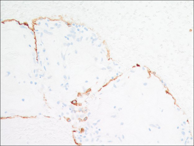 AE1/AE3 immunoreactivity is present in the surface cells but not the round cells (×200)