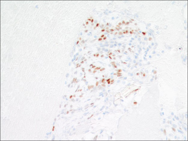 Progesterone receptor immunoreactivity is present in the round cells but not the surface cells (×200)