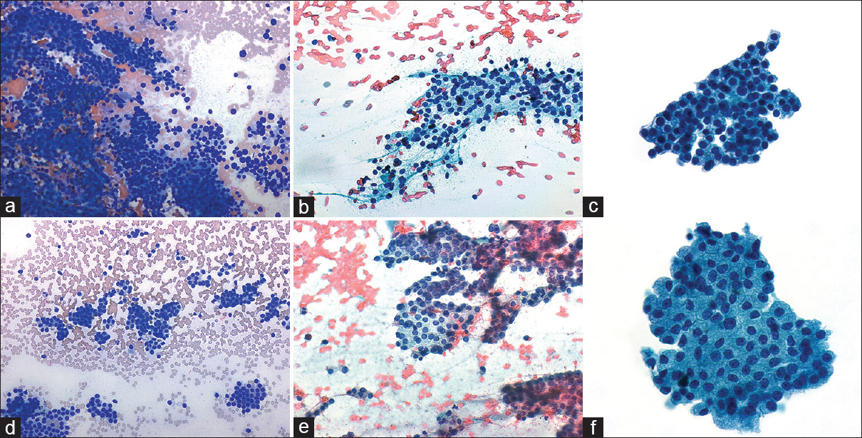 (a-c) Parathyroid. (d-f) Bethesda category-IV. (a and d) The predominant architectural patterns: Two-dimensional in (a) parathyroid and microfollicular in (d) Bethesda category-IV (Diff Quik, ×200). Many naked nuclei are present in both (b) parathyroid and (e) Bethesda category-IV but more single cells are observed in Bethesda category-IV (Pap, ×400). (c and f) A higher nuclear-to-cytoplasmic ratio of (c) parathyroid compared to (f) Bethesda category-IV. Nucleoli and nuclear irregularity are evident in Bethesda category-IV and absent in parathyroid (Pap, ×600)