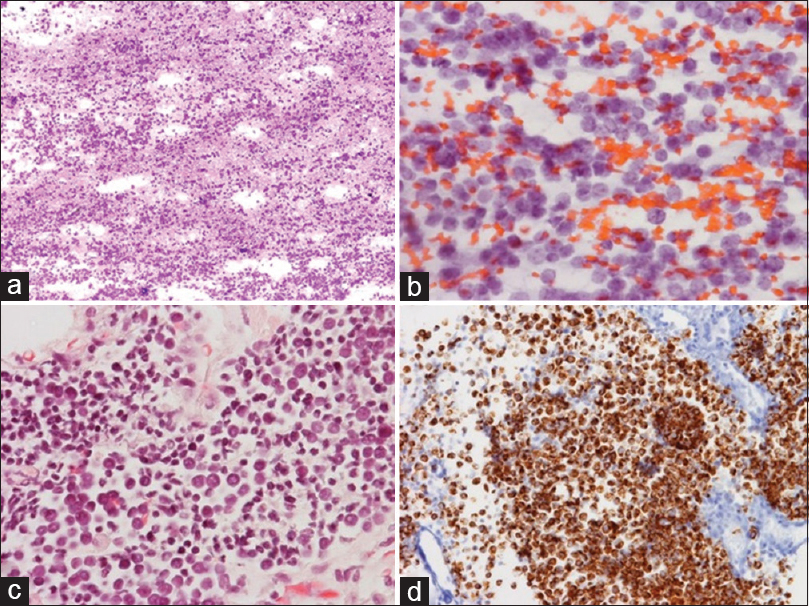 Fine needle aspiration of a solitary 5.5 cm hypermetabolic anterior mediastinum mass from a 69-year-old man with a previously resected right buttock Merkel cell carcinoma, (a) The high cellularity and loosely cohesive nature (Romanowsky, ×4); (b) The finely granular chromatin and round small nuclei (Papanicolaou, ×40); (c) Similar features (H and E of the cell block, ×40); (d) The malignant cells (Cytokeratin-20 of the cell block, ×40)