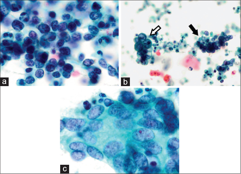 Cytological findings from the uterine cervical smear. (a) Cluster of small cells with high nuclear/cytoplasmic ratios or lacking cytoplasm was observed. Nuclei of small cell neuroendocrine carcinoma show hyperchromatic, finely stippled nuclear features and an Indian file pattern. (b) Both adenocarcinoma (white arrow) and small cell neuroendocrine carcinoma (black arrow) cells were observed in the proteinaceous debris-filled background (c) Adenocarcinoma showing a gland-like pattern. Tumor cells showed abundant cytoplasm, unevenly distributed large nuclei, and ground glass chromatin (Pap, a and c: ×1000; b: ×400)