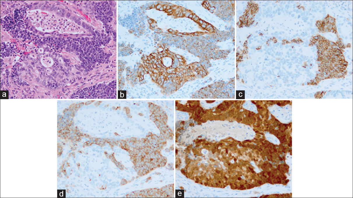 Histologic findings of uterine cervical carcinoma. (a) Small cell neuroendocrine carcinoma was present in some adenocarcinomatous components, showing a tubular pattern (H and E). Surrounding tubular structures and individual tumor cells were small and showed a high nuclear/cytoplasmic ratio and round or elliptical nuclei with nuclear molding. (b-e) Immunohistochemistry demonstrating the expression of various molecular markers. (b) Cervical adenocarcinoma exhibiting diffuse cytoplasmic staining for cytokeratin 19. (c and d) Small cell neuroendocrine carcinoma exhibiting diffuse cytoplasmic staining for CD56 and synaptophysin, respectively. (e) Both small cell neuroendocrine carcinoma and adenocarcinoma exhibiting diffuse, strongly cytoplasmic, and nuclear staining with p16 (a-e, ×200)