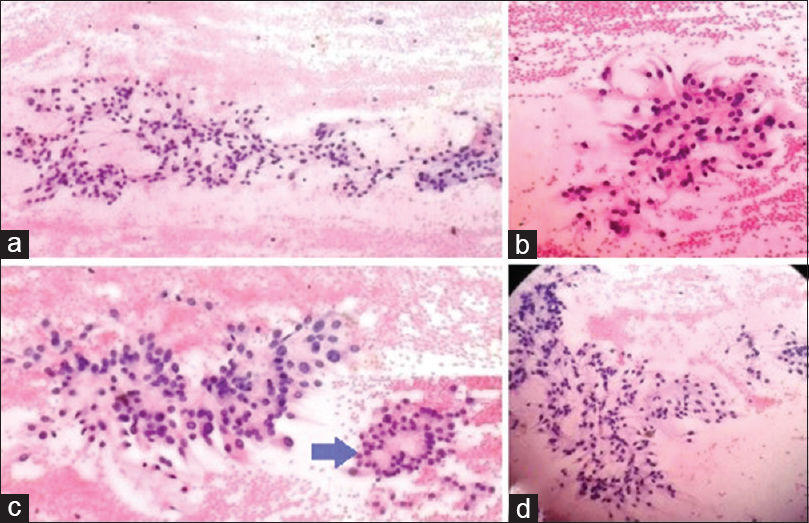 Fine needle aspiration of the thigh lesion. (a) Cytology shows loosely arranged round to oval cells having eosinophilic cytoplasm in the fibrillary and myxoid background (H and E,100 ×). (b) Many loosely arranged cuboidal to columnar cells having polar eosinophilic cytoplasmic process in fibrillary background (H and E, 100). (c) Cytology showing oval and spindle cells having mild cytologic atypia (H and E, 400). Inset (zoomed) cells arrangement in rosette fashion (arrow). (d) Round to oval cells having plasmacytoid nuclei and eosinophilic cytoplasm in the fibrillary and myxoid background (H and E, 100)