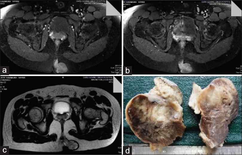 (a) Magnetic resonance imaging showing well-defined lobulated lesion shows heterogeneous enhancement on postcontrast study, approximately size (27 mm × 43mm × mm) is noted in subcutaneous plane, paramedian location in the left gluteal region. Anteriorly, it lesion reaches up to tip coccyx. (b) The lesion is hypointense onT1-weighted image. (c) The lesion is heterogeneously hyperintense onT2-weighted image. (d) Gross photograph shows subcutaneous tumor Heterogeneous gray-white and glistening brown cut surface