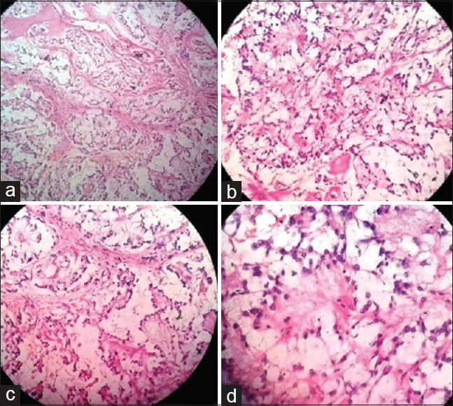 Histopathology of the thigh lesion. (a) Tumor cells arranged in lobules in myxoid background separated by fibrous septa (H and E, 200). (b & c) Tumor cells arranged in cords, trabeculae, and rosette like arrangement in the myxoid and fibrillary background (H and E, 400). (d) Tumor cells arranged in rosette with fibrillary material within (H and E, 400)