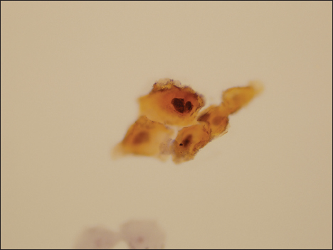 Photomicrograph of a specimen designated as atypical urothelial cell by two observers, as suspicious for high-grade urothelial carcinoma by a single observer, and as malignant by the final observer