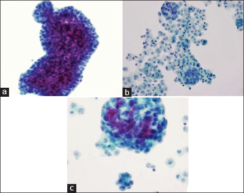 can anyone survive stage 4 pancreatic cancer