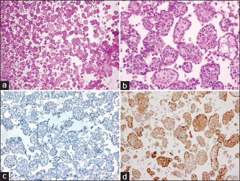 Cell block from pleural fluid (a) H and E, ×40 and (b) H and E, ×200 (b) immunohistochemical stain (c) BerEp4 ×100, (d) Calretinin ×100