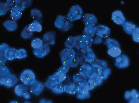 Fluorescence in situ hybridization study for 9p21 on cell block