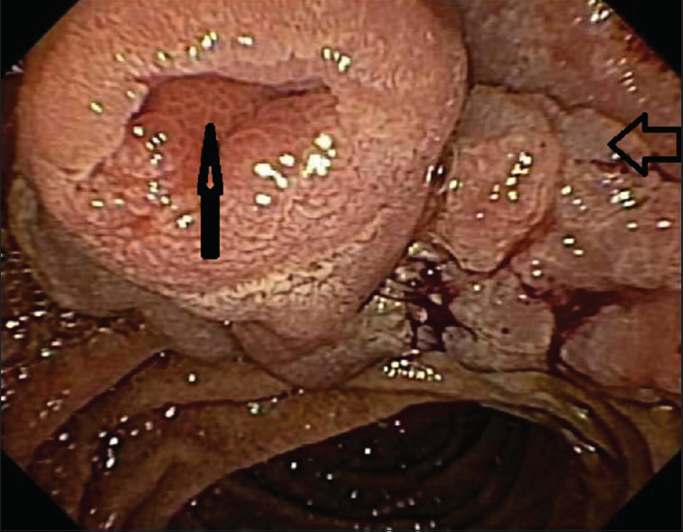 Endoscopic image showing an ampullary adenoma involving the ampullary orifice (vertical arrow), entire ampulla and spreading laterally (horizontal arrow)