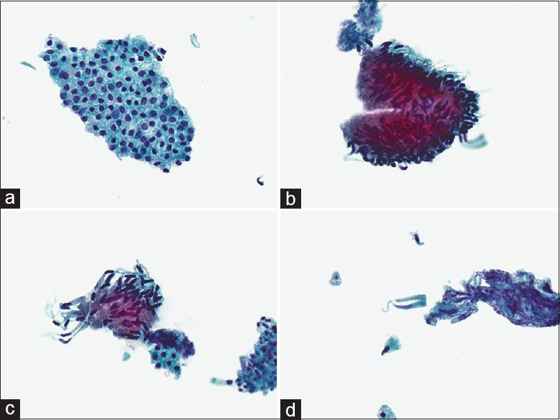 Cytologic features of tubular adenoma on Papanicolaou-stained ThinPrep specimen. (a) Normal bile duct glandular epithelium (×400), (b) adenoma epithelium with nuclear palisading and hyperchromasia (×400), (c) adenoma epithelium with nuclear hyperchromasia, elongated thin nuclei and smooth nuclear contours (×400), (d) scattered single cells derived from the adenoma (×400)