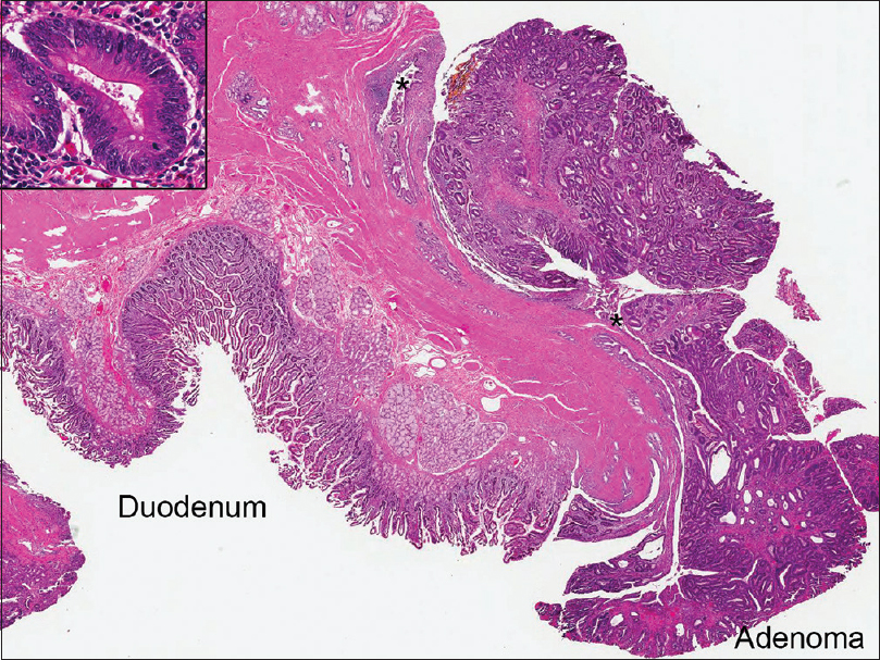 Subsequent Whipple resection demonstrating the ampullary tubular adenoma involving the distal common bile duct (*) (×10). The insert shows the high power morphology including nuclear pseudostratification, hyperchromasia, and increased mitotic activity (×400)