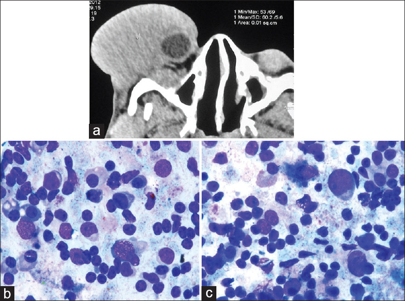 (a) Computed tomography, axial section showing a homogeneous enhancing soft-tissue swelling in the lateral aspect of the right orbit. A part of eyeball can be seen toward medial aspect; (b and c) Small to medium-sized lymphoid cells with condensed chromatin, inconspicuous nucleoli, and irregular nuclear contours with deep indentations along with many scattered plasma cells (MGG, ×100)