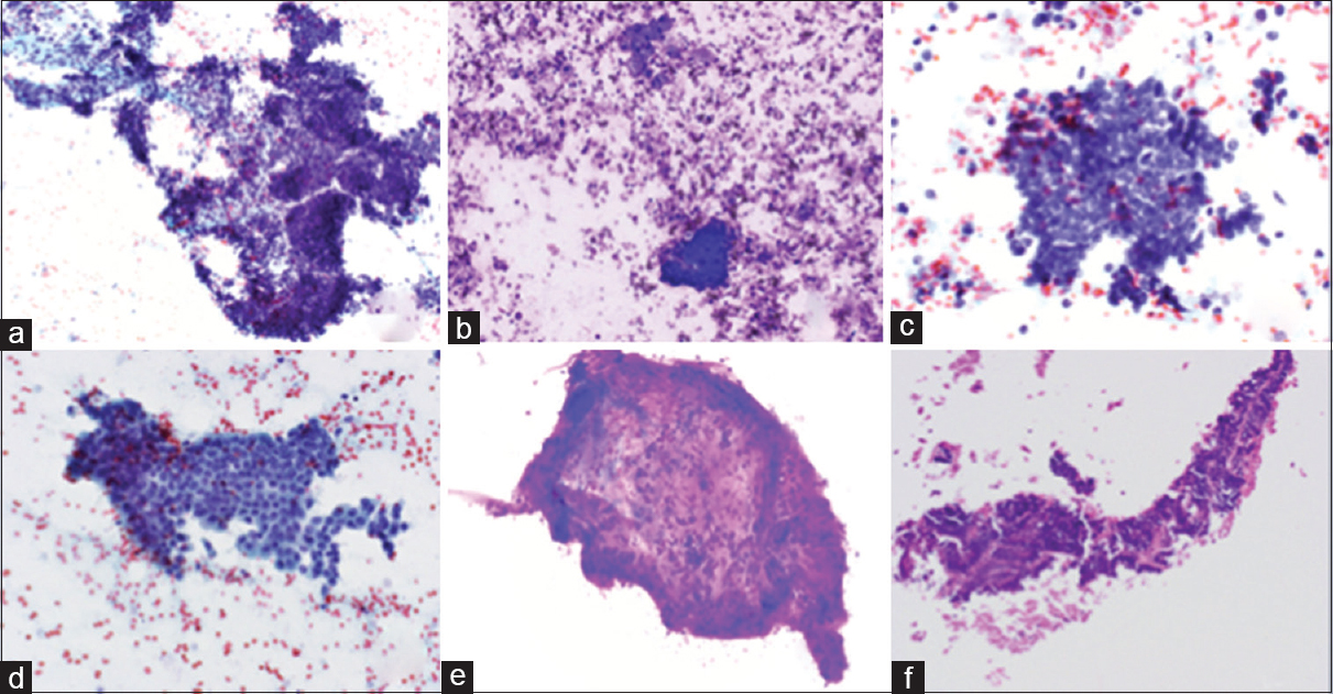 Photomicrographs of right renal fossa fine-needle aspiration smears. (a) Tissue fragment with stromal spindle cells and cluster of basaloid cells with scant cytoplasm (Papanicolaou, ×200). (b) Cluster of basaloid cells with scant cytoplasm (Diff-Quik, ×400). (c) High power view of cells with scant basaloid cytoplasm (Papanicolaou, ×600) (d) Sheet of bland cells with a moderate amount of cytoplasm (Papanicolaou, ×400). (e) Stromal fragment with spindle cells and metachromatic myxoid stroma (Diff-Quik, ×200). (f) Cell block with epithelial cells with metachromatic stromal material (H and E, ×200)